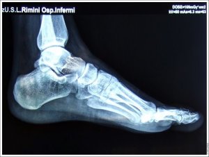 BrokenFoot